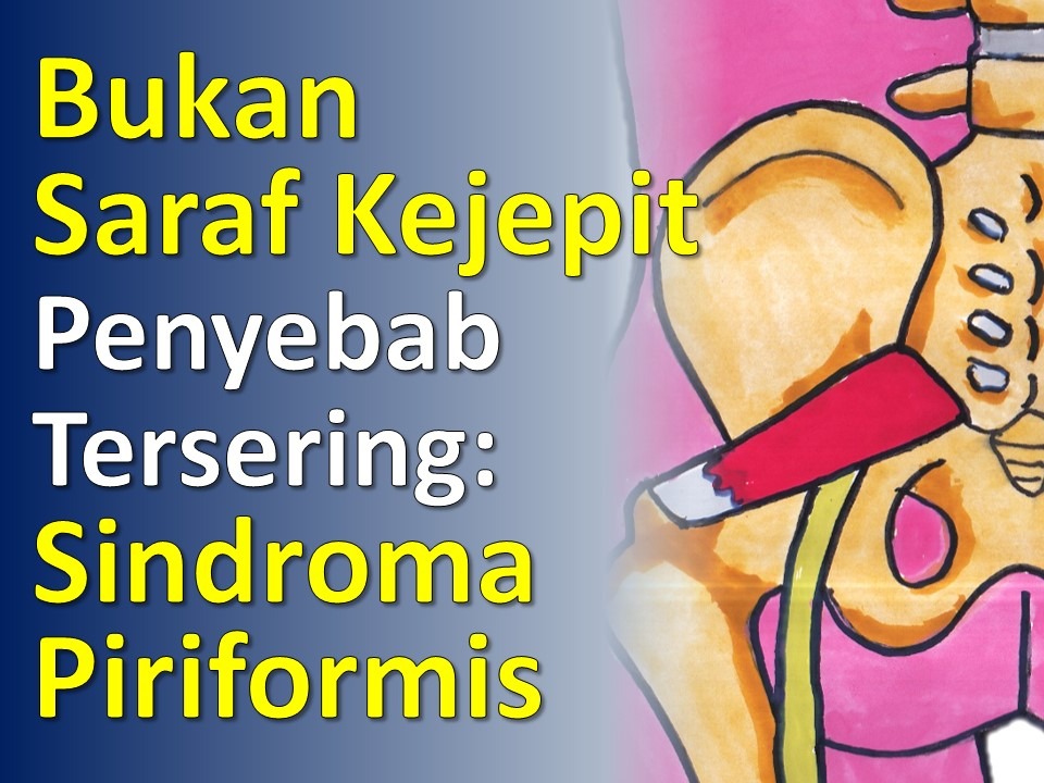Sakit Bokong Menjalar ke Kaki : Sindroma Piriformis Sakit Bokong Menjalar ke Kaki : Sindroma Piriformis