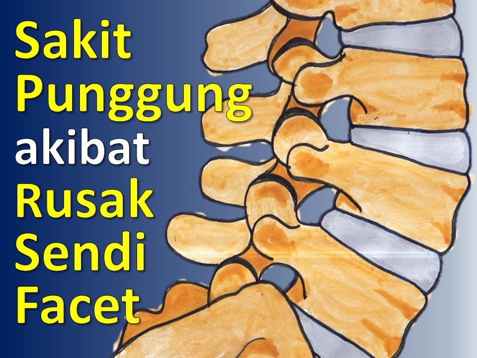Sakit Punggung Karena Rusaknya Sendi Kecil di Tulang Belakang Sakit Punggung Karena Rusaknya Sendi Kecil di Tulang Belakang