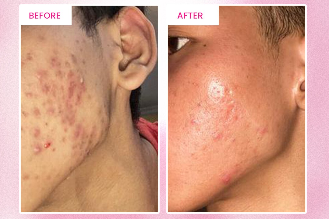 Jerawat Membandel Saat Puber? Atasi Tuntas dengan Acne Laser & Black Peeling di Alamin Skincare Jerawat Membandel Saat Puber? Atasi Tuntas dengan Acne Laser & Black Peeling di Alamin Skincare