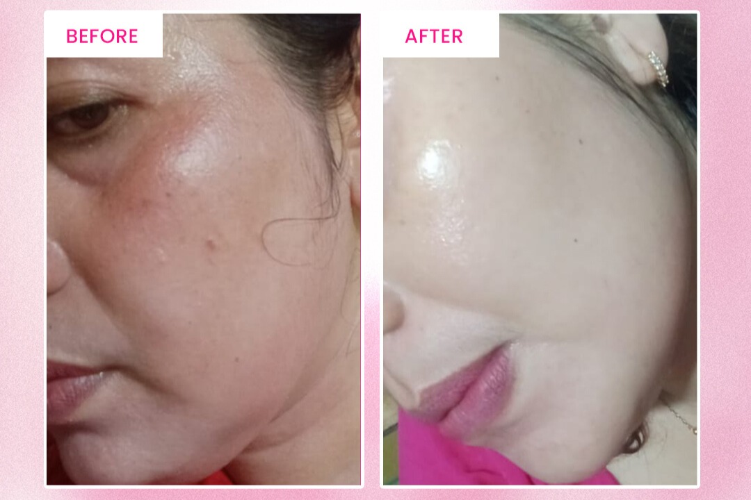 PICO Laser Alamin Skincare: Lihat Sendiri Before-After Flek Hitam Hilang Hanya Dalam Beberapa Sesi! PICO Laser Alamin Skincare: Lihat Sendiri Before-After Flek Hitam Hilang Hanya Dalam Beberapa Sesi!