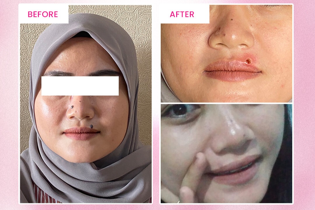 Tahi Lalat Hilang Tanpa Bekas Hanya Sekali Treatment di Alamin Skincare Tahi Lalat Hilang Tanpa Bekas Hanya Sekali Treatment di Alamin Skincare