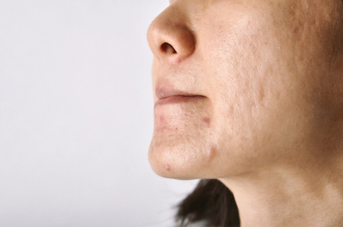 Risiko Asal Pilih Skincare Dari Breakout hingga Skin Barrier Rusak Risiko Asal Pilih Skincare Dari Breakout hingga Skin Barrier Rusak