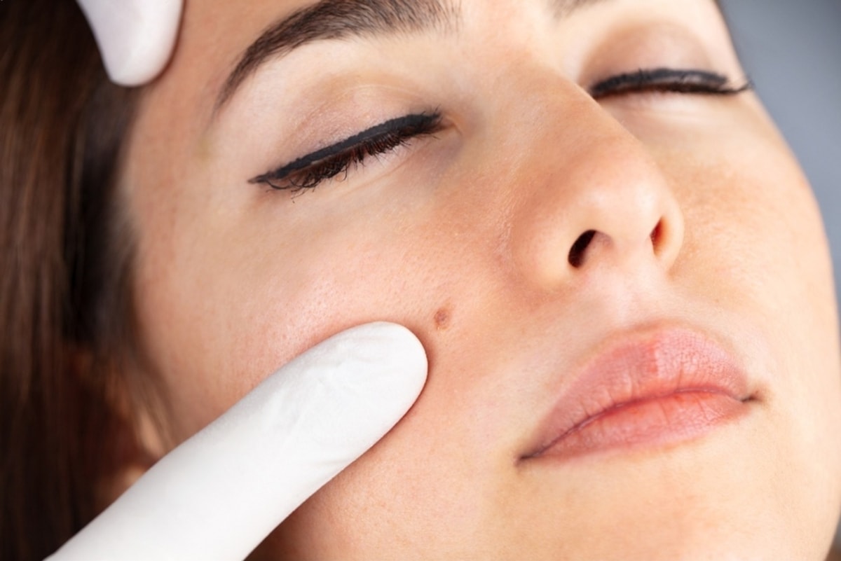 Mau Wajah Bebas Tahi Lalat? Kenalan dengan CO2 Laser Al Amin Skincare Mau Wajah Bebas Tahi Lalat? Kenalan dengan CO2 Laser Al Amin Skincare