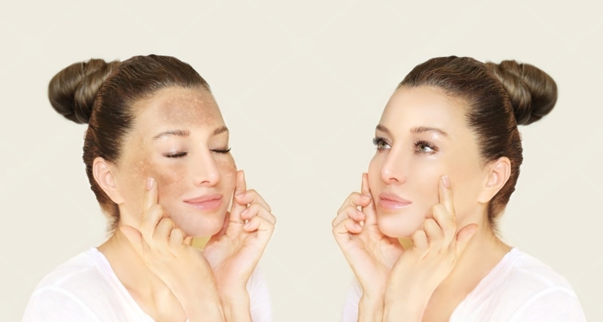 Wajah Kusam Karena Flek? Begini Cara Mencerahkannya Wajah Kusam Karena Flek? Begini Cara Mencerahkannya