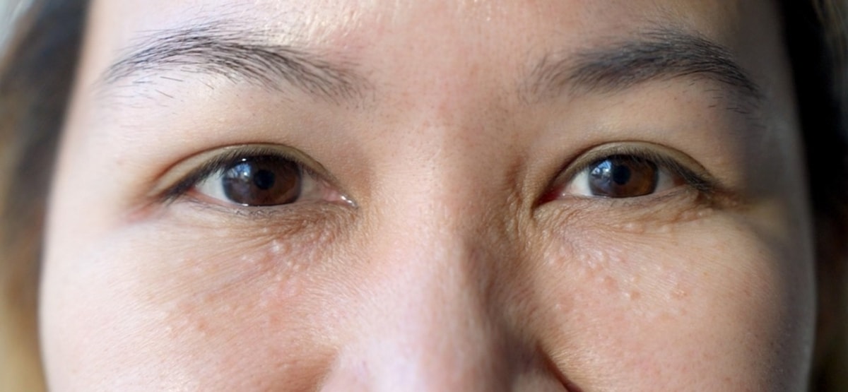 Milia Bintik Putih Kecil yang Sering Muncul di Area Mata & Pipi, Begini Penjelasannya! Milia Bintik Putih Kecil yang Sering Muncul di Area Mata & Pipi, Begini Penjelasannya!