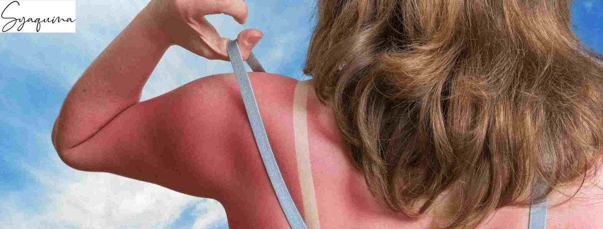 Tips mengatasi sunburn luka bakar akibat sinar matahari Tips mengatasi sunburn luka bakar akibat sinar matahari