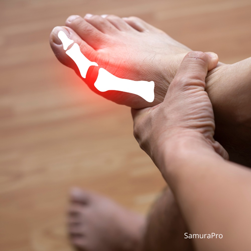 Kenapa Asam Urat Sering Kambuh Saat Cuaca Dingin? Ini Penjelasan Medisnya