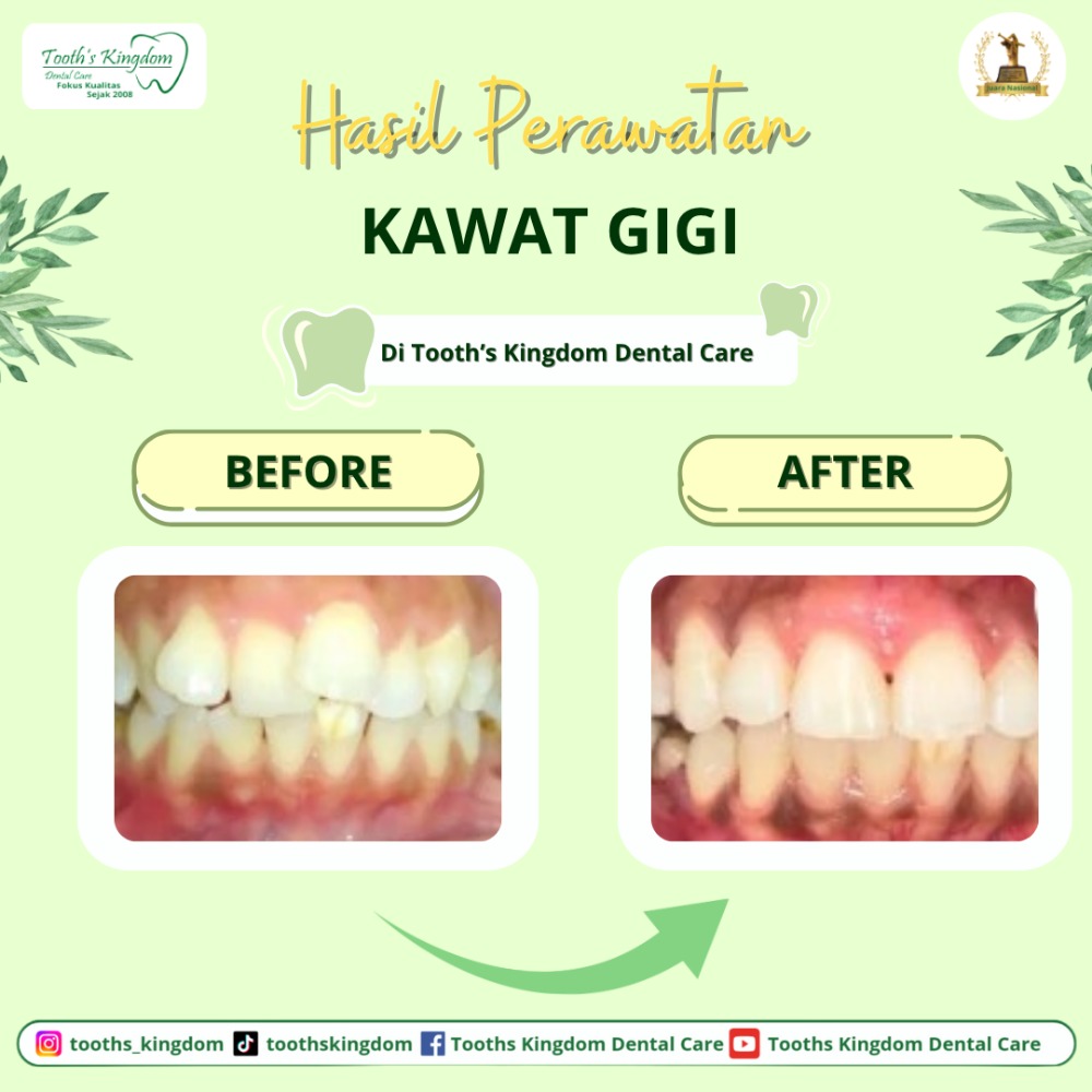 behel / kawat gigi