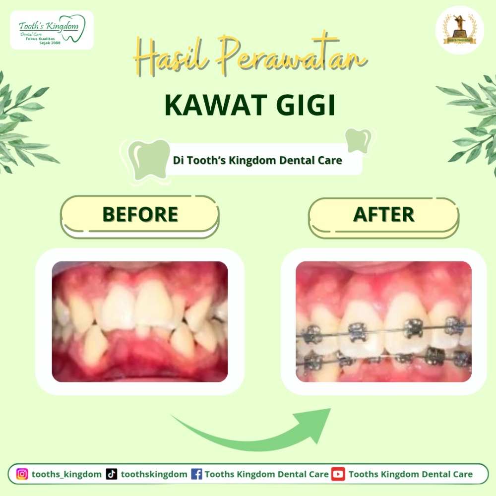 behel / kawat gigi
