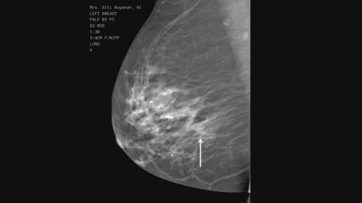 Hasil Mammografi Ibu Siti Ruhayan Pada Pemeriksaan Berikutnya Terlihat Jaringan Kanker Sudah Mulai Menyebar