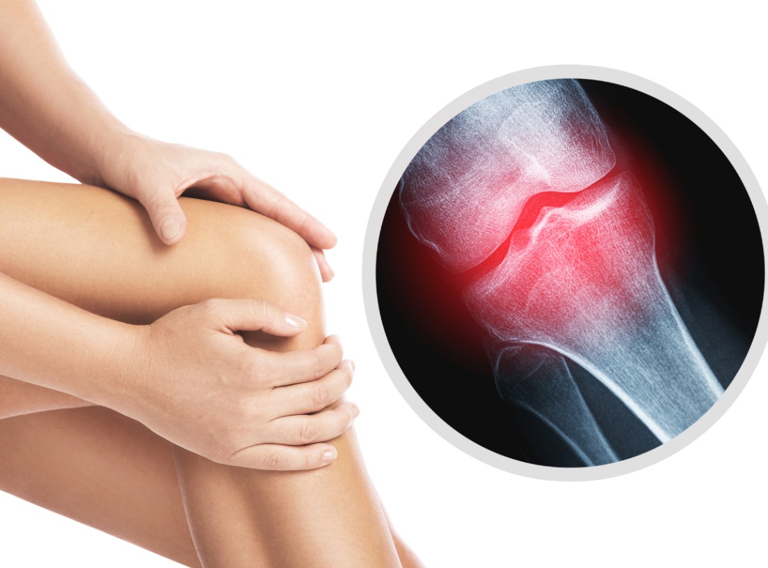 Cara Mencegah Osteoartritis Sejak Usia Muda