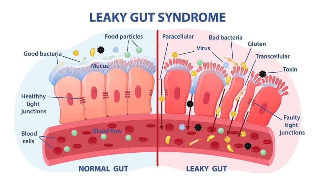 Healing Leaky Gut: Comprehensive Fiber and Probiotic Strategies by BloomLab