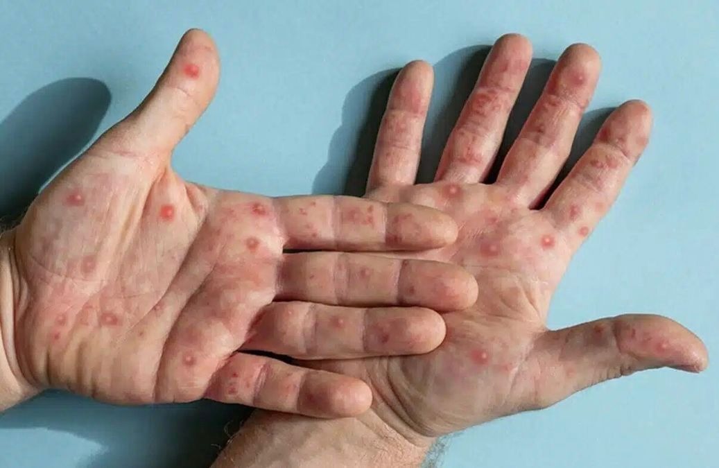 Eksim Dishidrosis: Benarkah Menular ke Orang Lain?