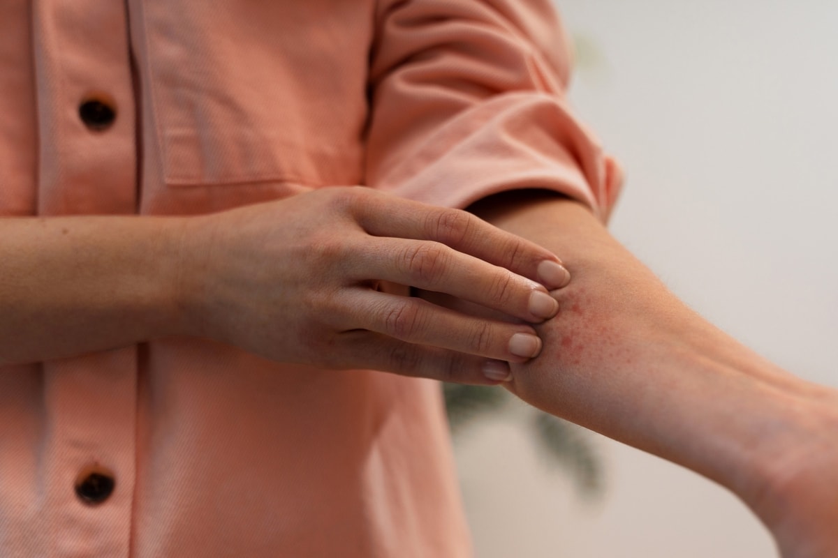 Eksim atau Pityriasis Rosea? Kenali Cara Membedakannya!