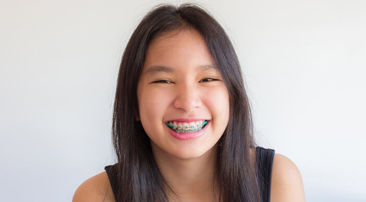 Oral Hygiene Tips for People with Braces