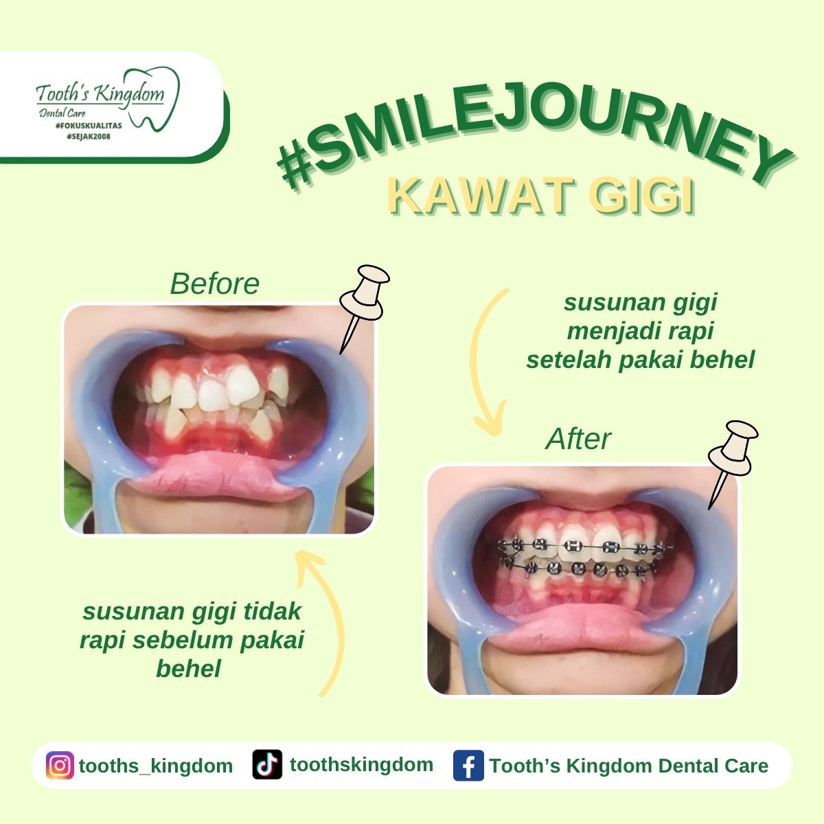 behel/ kawat gigi