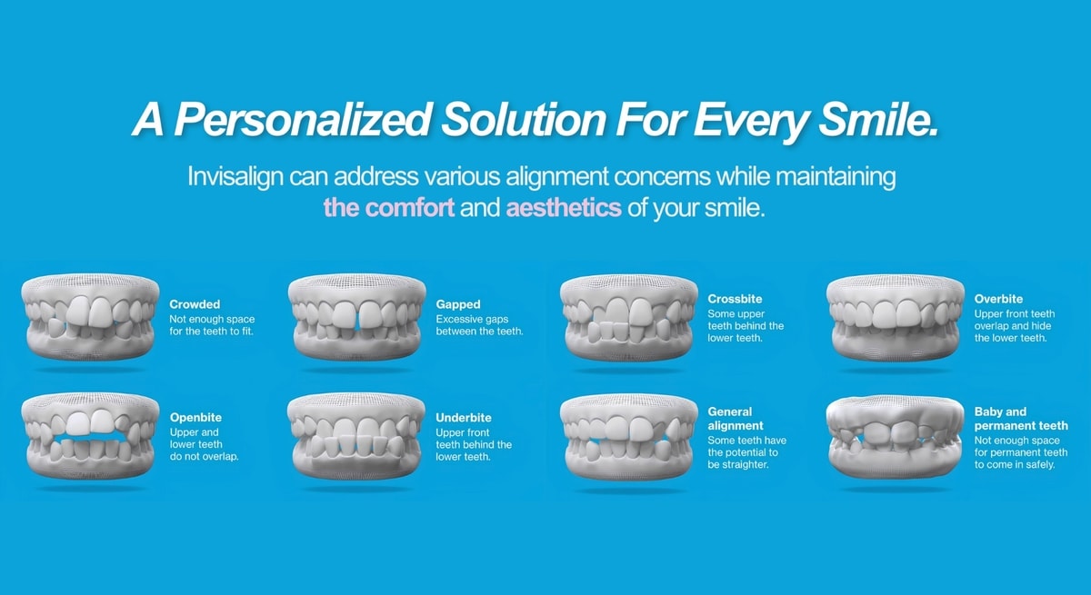 invisalign for every smile