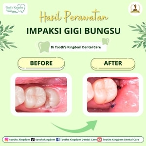 gigi bungsu