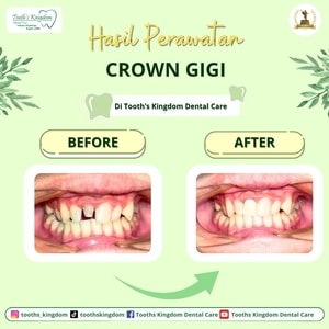 Gigi palsu