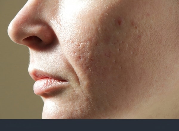 Bopeng Bikin Hilang Percaya Diri? Ini Rekomendasi Perawatan yang Tepat dari Alamin Skincare