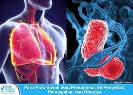 Radang Paru-paru (Pneumonia), Kenali Gejala, Penyebab, dan Pengobatannya