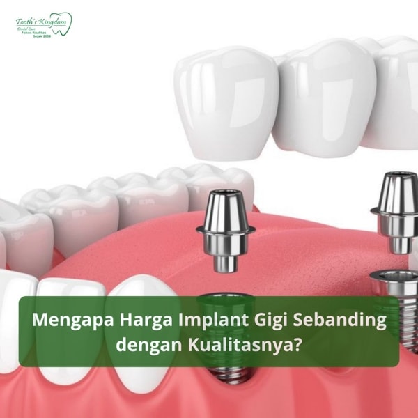 Investasi Jangka Panjang: Mengapa Harga Implan Gigi  Sebanding dengan Kualitasnya?