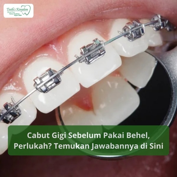 Cabut Gigi Sebelum Pakai Behel, Perlukah? Temukan Jawabannya di Sini