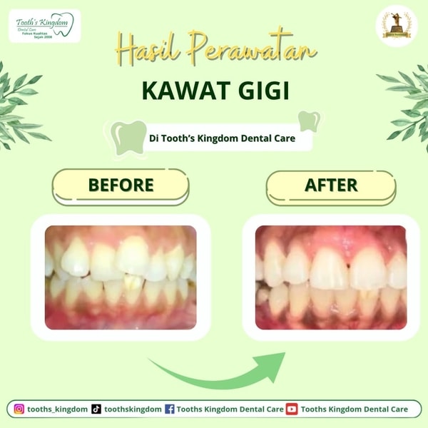 behel / kawat gigi