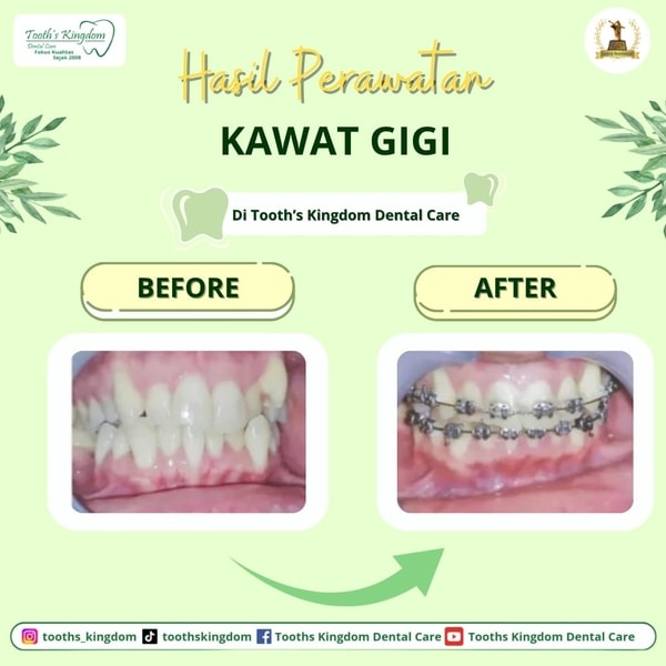 behel / kawat gigi