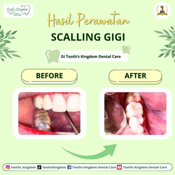 Scalling gigi / Pembersihan karang gigi