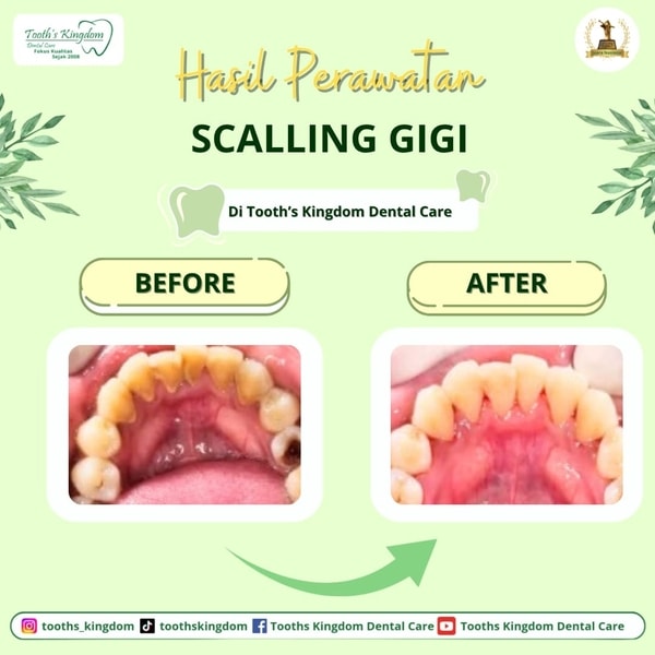 Scalling gigi / Pembersihan karang gigi