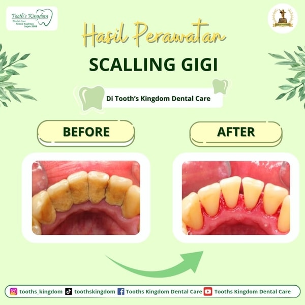Scalling gigi / Pembersihan karang gigi