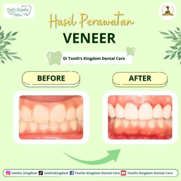 Veneer gigi