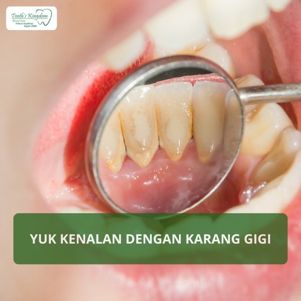 YUK KENALAN DENGAN KARANG GIGI