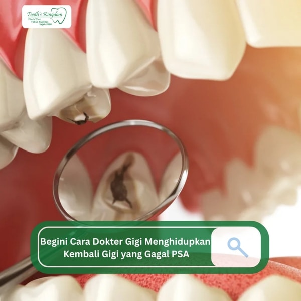 Bukan Dicabut! Begini Cara Dokter Gigi 'Menghidupkan' Kembali Gigi yang Gagal Perawatan Saluran Akar