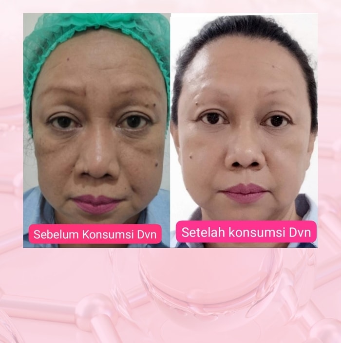 dvn dvn original dvn asli  dvn collagen dvn colagen dvn collagen asli dvn collagen original  dvn kolagen wellous dvn dvn collagen official store