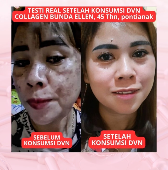 dvn dvn original dvn asli  dvn collagen dvn colagen dvn collagen asli dvn collagen original  dvn kolagen wellous dvn dvn collagen official store