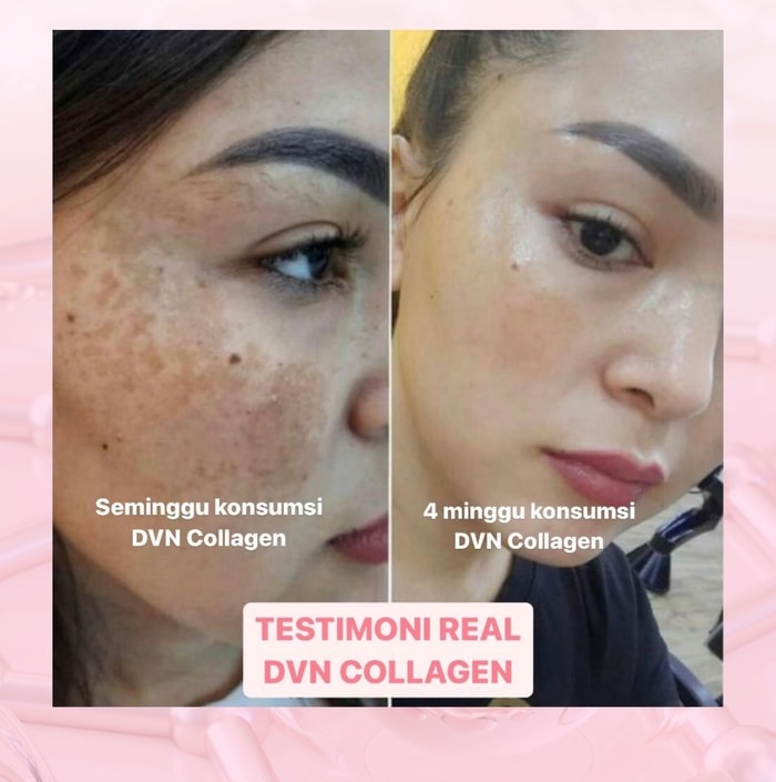 dvn dvn original dvn asli  dvn collagen dvn colagen dvn collagen asli dvn collagen original  dvn kolagen wellous dvn dvn collagen official store