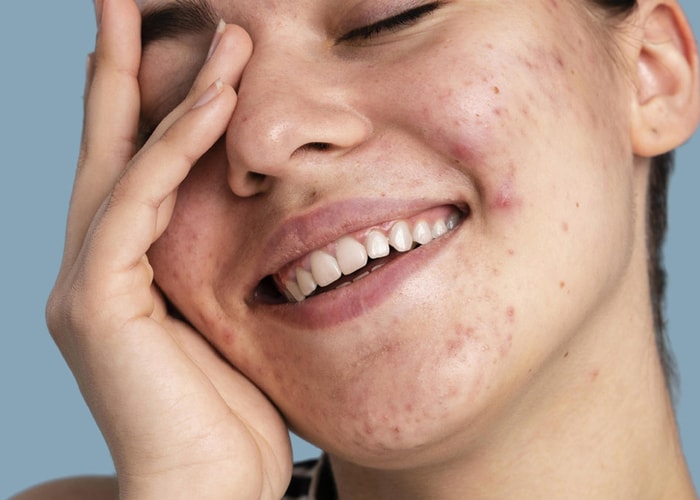 Mengapa Sunscreen Penting untuk Kulit Berjerawat ?