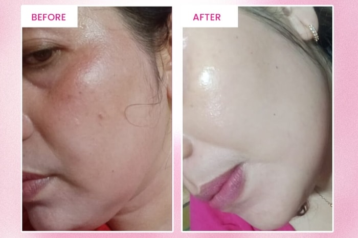 PICO Laser Alamin Skincare: Lihat Sendiri Before-After Flek Hitam Hilang Hanya Dalam Beberapa Sesi!