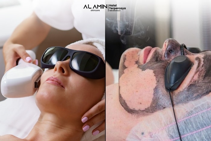 PICO Laser & Skin Booster Alamin Skincare: Revolusi Kulit Cerah Bebas Noda Hitam