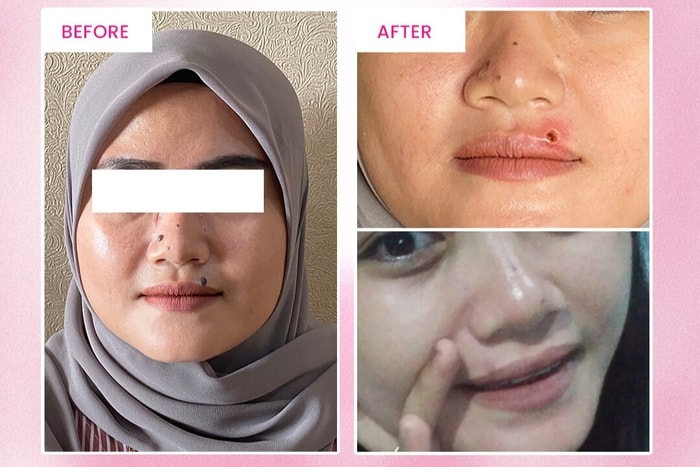 Tahi Lalat Hilang Tanpa Bekas Hanya Sekali Treatment di Alamin Skincare