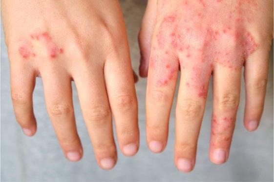 Pilihan Pakaian dan Sepatu yang Ramah untuk Eksim Dishidrosis