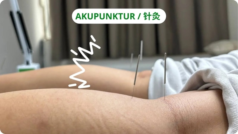 akupunktur / akupuntur