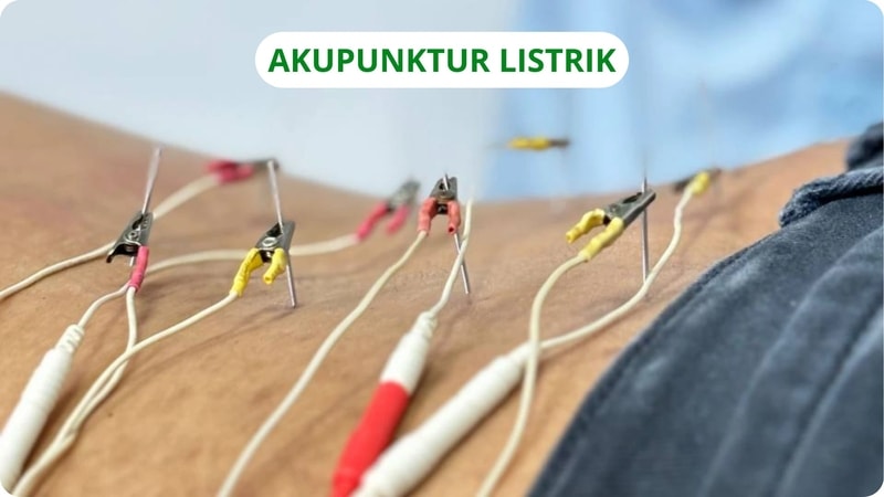 akupunktur listrik