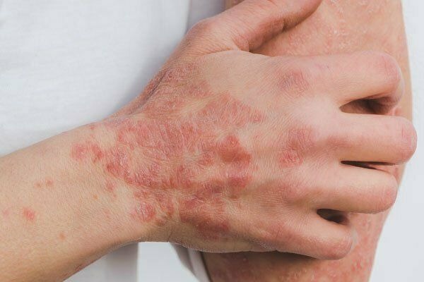 7 Mitos tentang Dermatitis Atopik yang Perlu Diketahui!