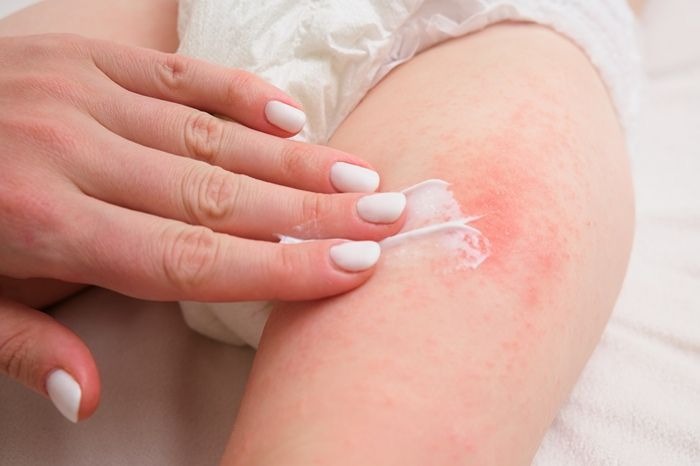 Mengapa Dermatitis Atopik Lebih Rentan Menyerang Anak-Anak Dibanding Orang Dewasa?
