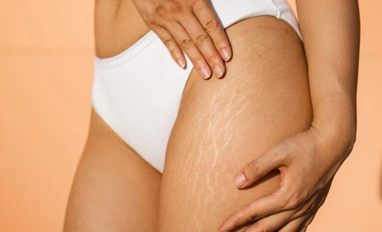 Hindari Stretch Mark Saat Hamil dengan 5 Cara Efektif Ini!