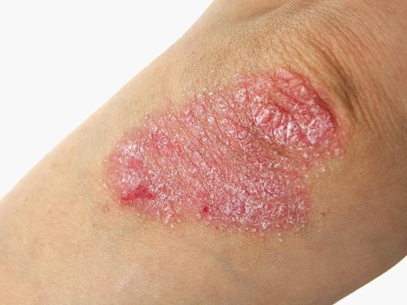 Psoriasis: Penyakit Kulit Kronis yang Sering Disalahpahami