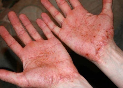 Kenapa Eksim Dishidrosis Lebih Sering Kambuh?